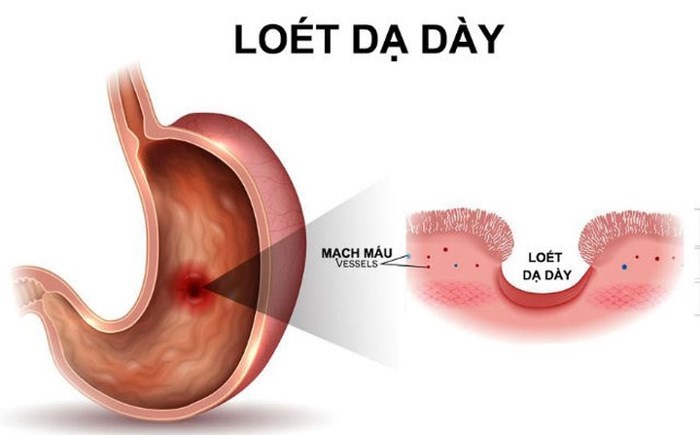 loét dạ dày 